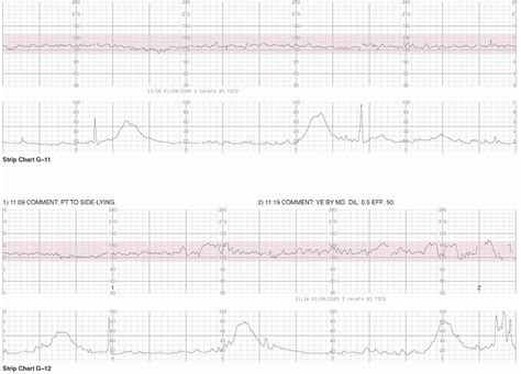 fetal monitor strips practice|Electronic Fetal Monitoring [+ Free Cheat Sheet] .